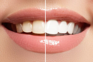 Close-up of a smile showing the dramatic difference between teeth before and after professional whitening, highlighting the transformation to a brighter, whiter smile.